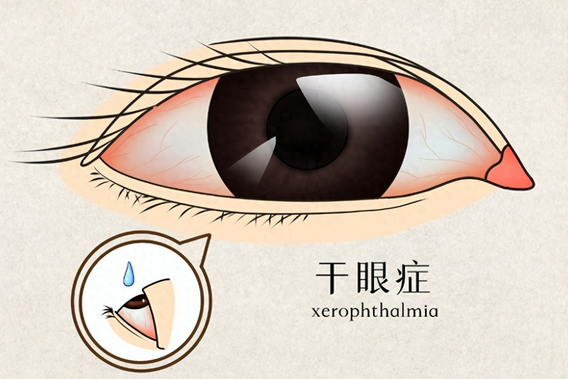 什么是干眼症？对眼睛有什么害处？
