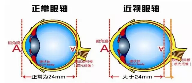 什么叫轴性近视？轴性近视防控方法有哪些？